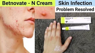 Betnovate N Cream Review  Benefits amp Uses  Betnovate N Cream for Face Acne Pimples [upl. by Oletta]