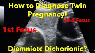 Twin Pregnancy  Diamniotic Dichorionic how to diagnose  easy steps [upl. by Dnomyaw836]