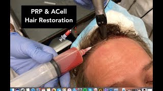 PRP amp ACell Hair Restoration  Dr Weiner Narrates His Own Treatment [upl. by Acalia393]