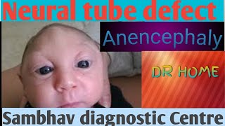 Anencephaly Neural tube defect Drshikha Agarwal Drhomeclass 12 biology [upl. by Mun]