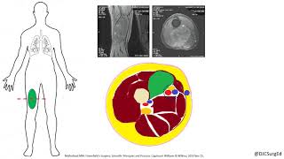 Soft Tissue Sarcoma [upl. by Duvall]