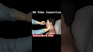 ng tube insertion procedure  ng tube foryou shorts [upl. by Yetnruoc]