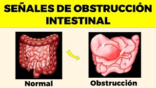 OBSTRUCCIÓN INTESTINAL Señales de Alerta Que Nunca Debes Ignorar [upl. by Ayel185]