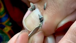 HOW TO CUT THICK TOENAILS  Toenail Cleaning Satisfying 22 [upl. by Htenek]