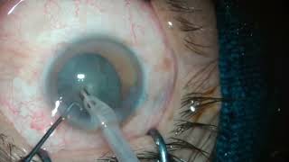 Phacoemulsification in small pupil  uveitic cataract [upl. by Eicarg]