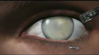 Medical Breakthrough Restoring Sight to the Blind [upl. by Aimerej]