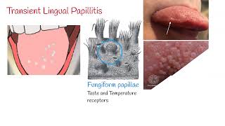 Transient lingual papillitis Lie Bumps  Inflammation of the tongue [upl. by Gertrude]