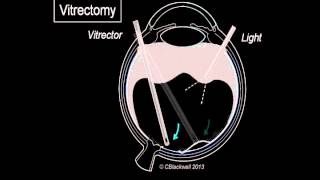 Vitreous 3 Vitrectomy Surgery [upl. by Assilav]