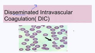 Disseminated Intravascular Coagulation DIC [upl. by Teador144]