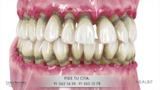 Periodoncia  gingivitis y periodontitis o quotpiorreaquot [upl. by Eugilegna]