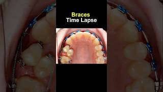 Braces time lapse Before and after transform braces orthodontist bracesoff dentist [upl. by Purington]