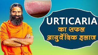 Ayurvedic Treatment Of Urticaria शीतपित्त  Swami Ramdev [upl. by Payson]