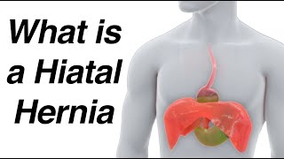 What is a Hiatal Hernia Animation amp How It Causes Reflux [upl. by Arob]