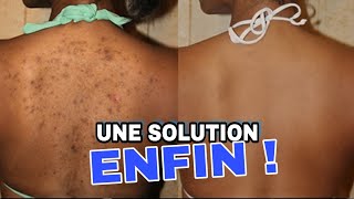 BOUTONS DANS LE DOS  ACNE ON BACK TREATMENT [upl. by Rendrag]