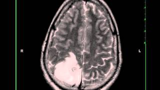 Oligodendroglioma [upl. by Simetra]