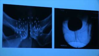 Symposium urologie prostaatkanker 6 december 2014  Dr Elke Blyweert [upl. by Lrub]