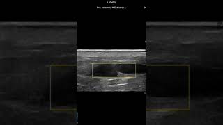 Incompetencia valvular Doppler Venoso Ecografia doppler Dra Jeremmy doctoraecos [upl. by Llyrehc]