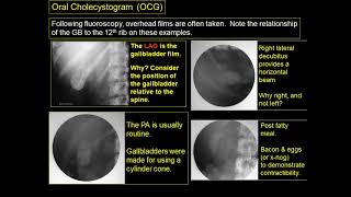 Radiography of the biliary system [upl. by Lisa]