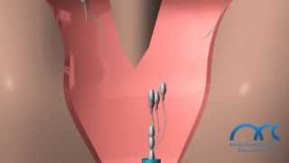 IUI Treatment Procedure  Intra Uterine Insemination Process in India  ARC Rsearch Centre Chennai [upl. by Nnaycart]