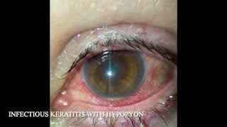 INFECTIOUS KERATITIS WITH HYPOPYON [upl. by Hakan]