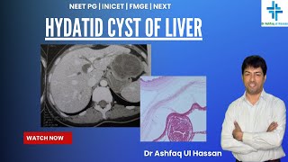 Hydatid Cyst of Liver  An important Question asked in FMGE 2024  Expected in NEET PG [upl. by Kimbra]