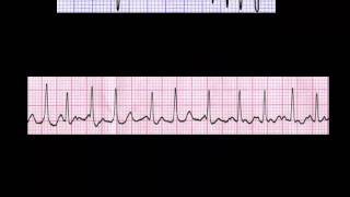 CURSO DE ELECTROCARDIOGRAFIA 24  AUTOEVALUACIÓN SOBRE MEDICIÓN DE FRECUENCIA [upl. by Atined]