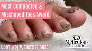 How to Pedicure Transformation the Most Compacted amp Misshapen Toenails [upl. by Ahsirkal807]