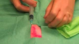 Suturing 1 Infiltrating local anaesthetic [upl. by Peisch747]