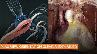 Parasternal long axis echocardiographic view anatomy POCUS pearls  Dr Koratala [upl. by Notse]