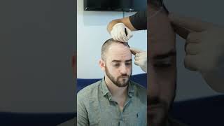 HAIR TRANPLANT TURKEY  MEDART HAIR ISTANBUL  hairtransplantbeforeafter [upl. by Ahaelam]