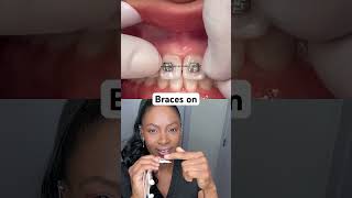 Dental Hygienist explains shorts braceson [upl. by Delinda]