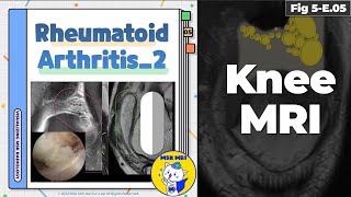 Fig 5E05 Rheumatoid Arthritis  Rice Bodies [upl. by Akital]