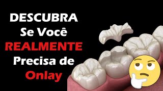 Onlay e Inlay  Como Saber se REALMENTE Preciso do Bloco Dentário  O Que é Preço Indicações [upl. by Nothgierc]