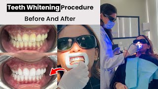 Teeth Scaling Polishing and Whitening Procedure Step By Step  Female Dentist in Lahore [upl. by Ysirhc472]