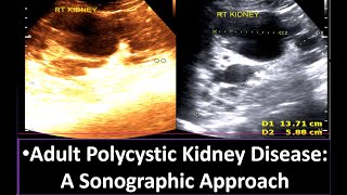 Understanding Adult Polycystic Kidney Disease A Sonographic Approach  Polycystic Kidney Disease [upl. by Saenihp]