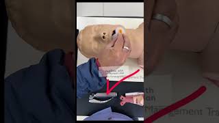 OROPHARYNGEAL AIRWAY INSERTION TECHNIQUE criticalcaremedicine emergencymedicine airwaymanagement [upl. by Iila]