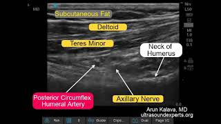 Ultrasound Guided Axillary Nerve Block [upl. by Aspasia]