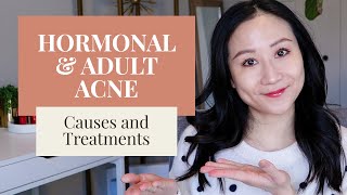 Treating Hormonal Acne  Dermatologist Tips [upl. by Caputto]