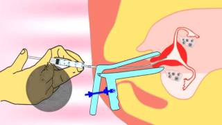 Intrauterine insemination IUI IUTPI the new method of insemination video [upl. by Frodi]