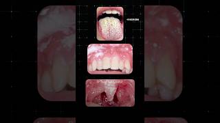 வாயில் ஏற்படும் பூஞ்சை தொற்று Oral Thrush Dr Isacc Abbas [upl. by Eenrahc]