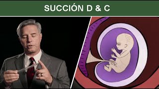 Aborto Quirúrgico durante el Primer Trimestre Succión D amp C Dilatación y Curetaje [upl. by Aisul667]