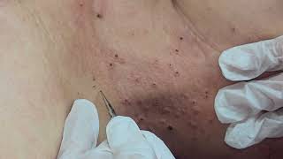 Warts and Syringoma Removal [upl. by Tyra]