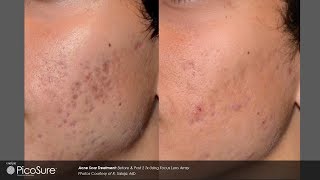 Laser Acne Scar Removal  Pulse light Clinic London [upl. by Vania]