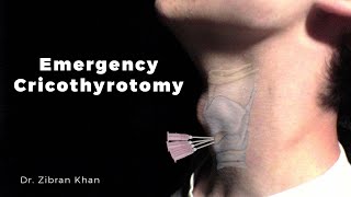 Emergency Cricothyrotomy at a Dental Office  Dr Zibran Khan [upl. by Stephana]