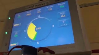 Kidney Dialysis Session start via a Fistula in the left arm using a Fresenius 5008 Machine [upl. by Llewen859]