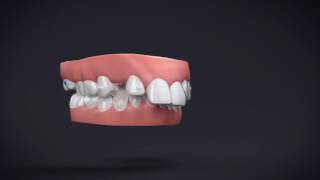 Invisalign Treatment with Mandibular Advancement 11 [upl. by Ulphiah]