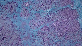 006 Intradermal nevus Histology HEA50 stain [upl. by Elnar]