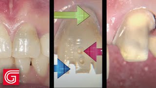 HOW TO Prepare Anterior Teeth Using a Reverse Preparation Technique [upl. by Devlen208]