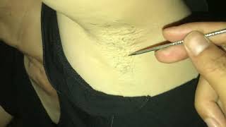 Pull out ingrown armpit hair removal for ms kiẹnhfdsaq ASMR [upl. by Ahsened975]