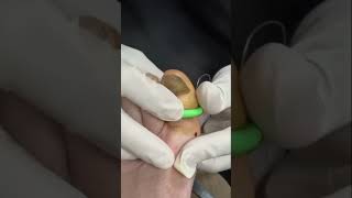 How to treat Toenail Fungus🤯 [upl. by Akahc]